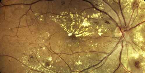 close up scan of the eye and macular disease